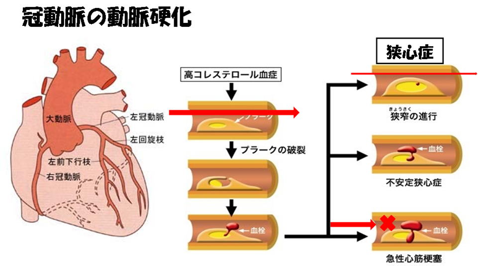 冠動脈の動脈硬化
